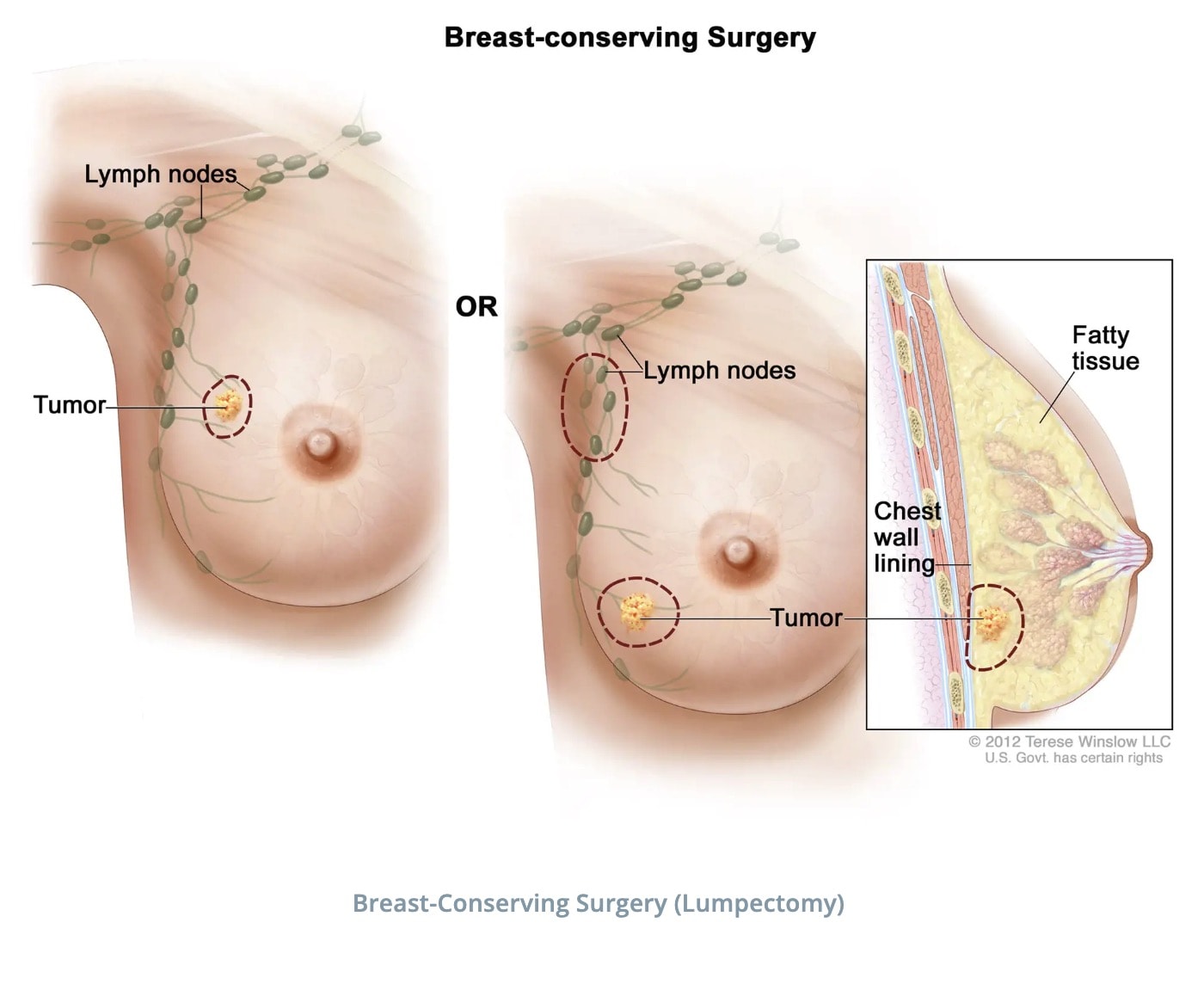 Breast Conserving Treatment Lumpectomy and Sentinel Node Biopsy